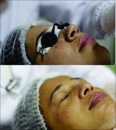 Despigmentação Dermofotônica  de Hipercromia com Fototerapia    (2 casos completos melasma) não invasivo.